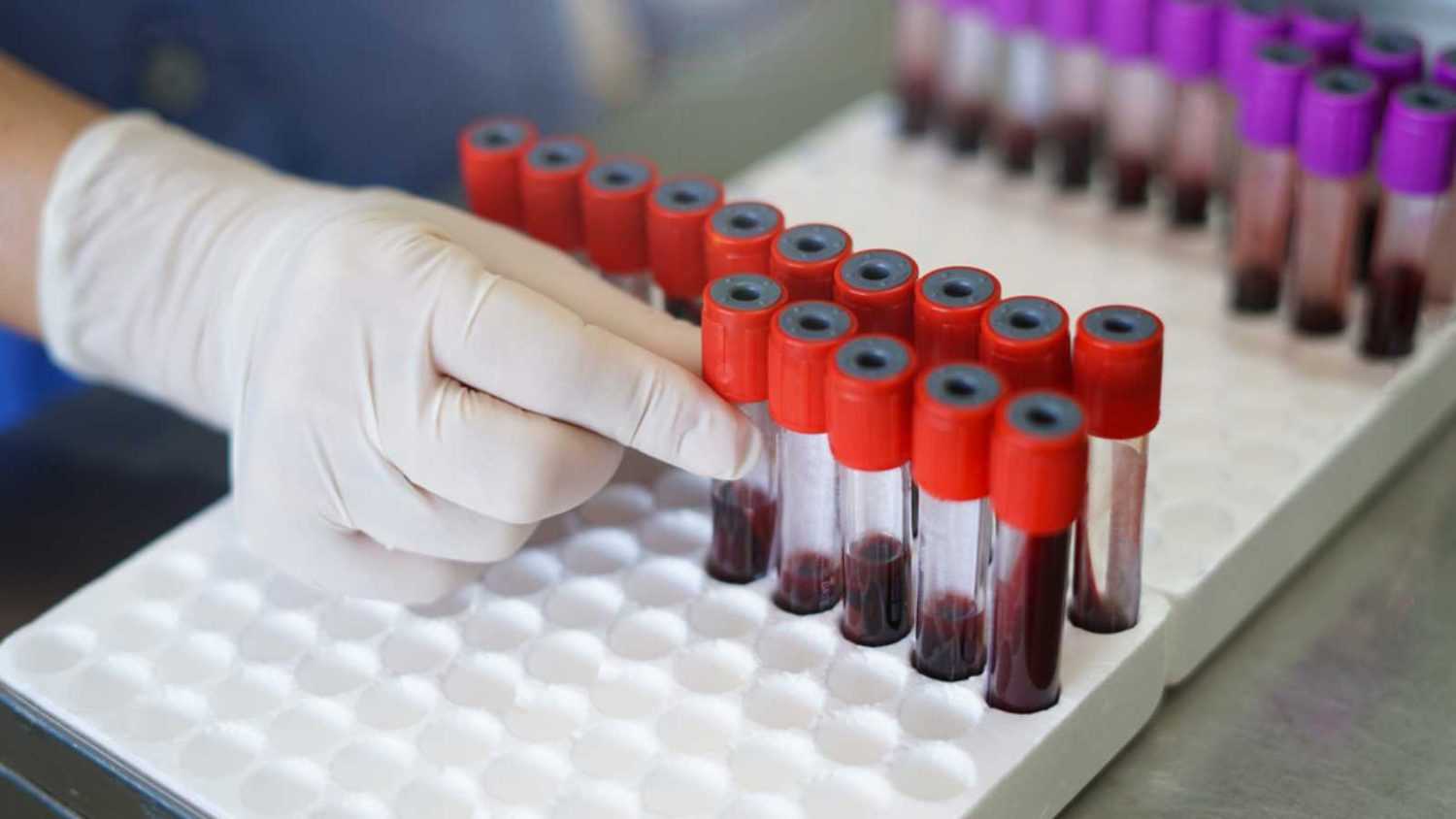 Blood taken from various patients for blood test